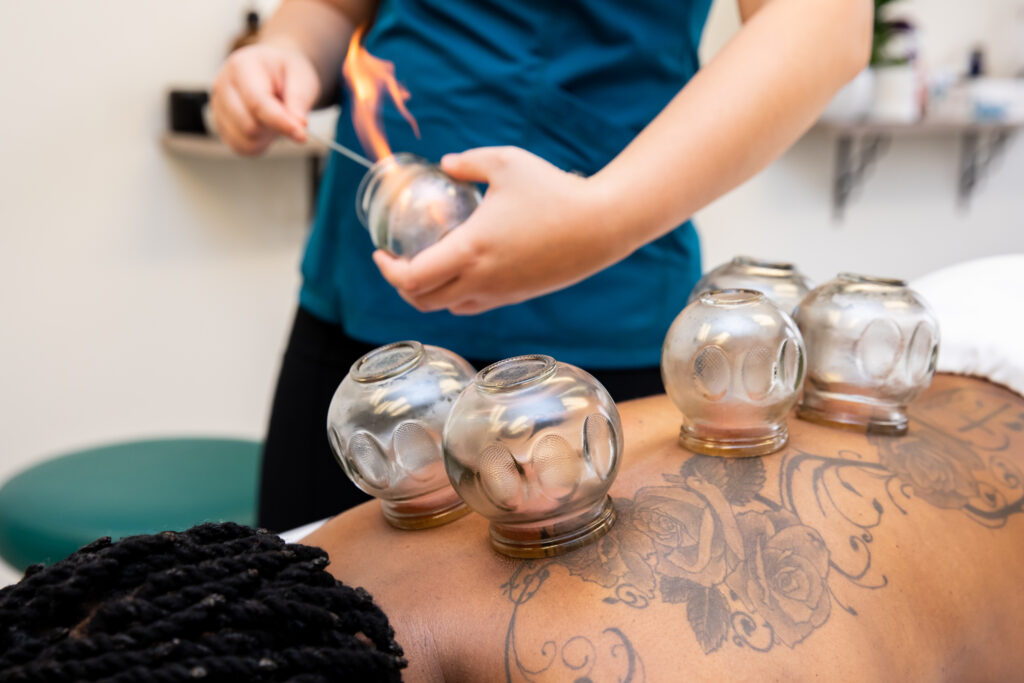 Photo of provider using fire to create suction in glass cup for cupping on a patient's back