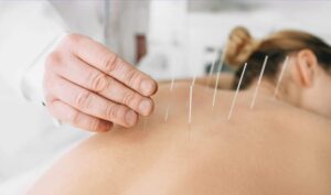 Closeup of a hand carefully placing acupuncture needles in a patient's upper back. The patient is face down, has her hair in a bun, and looks relaxed.