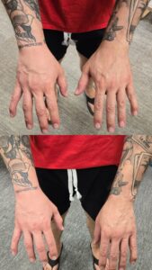 Close up of a man's tattooed arm, showing reduced swelling after combing Platelet Rich Plasma (PRP) injections and Hyperbaric Oxygen Therapy (HBOT.)