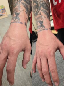 Close up of a man's tattooed arm, showing reduced swelling after combing Platelet Rich Plasma (PRP) injections and Hyperbaric Oxygen Therapy (HBOT.)